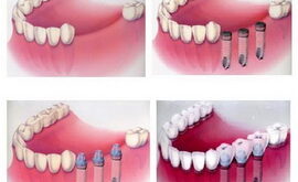 Имплантация — здоровые и красивые зубы надолго