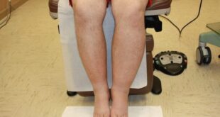 Лимфостаз — причины, симптомы и стадии заболевания